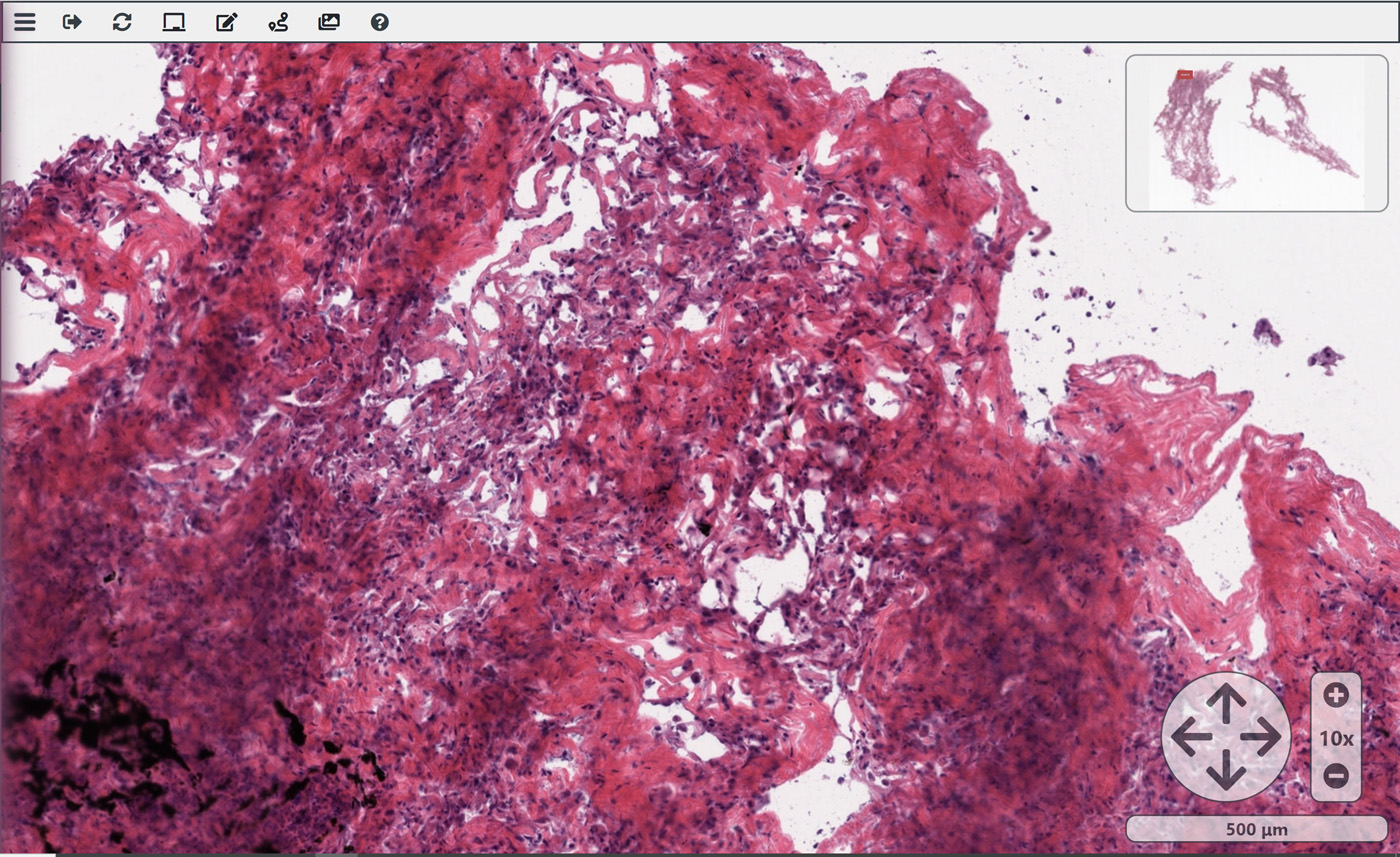 Artificial intelligence would reduce time to diagnose cancer